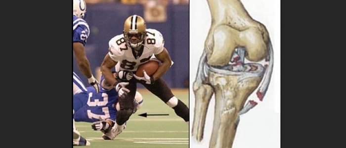 Mecanismos de lesión de partes blandas de rodilla: Ligamentos y meniscos.