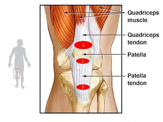 La ¿tendinitis? rotuliana