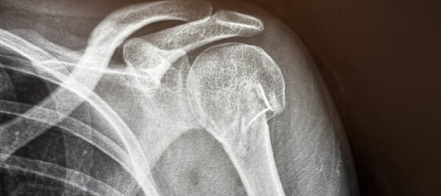 Discusión de Casos en Fractura de Húmero Proximal